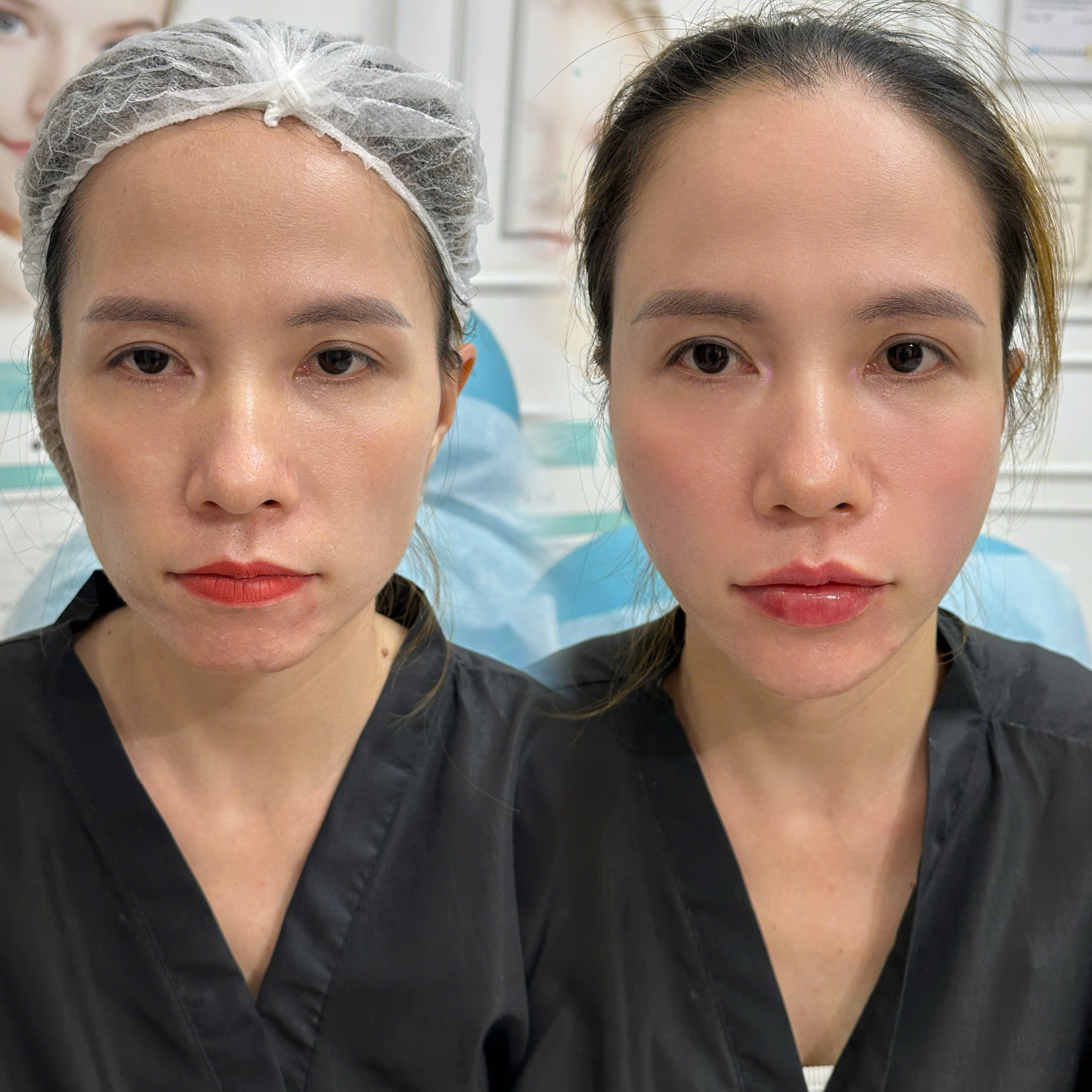 Kết quả Nâng tầng mặt giữa