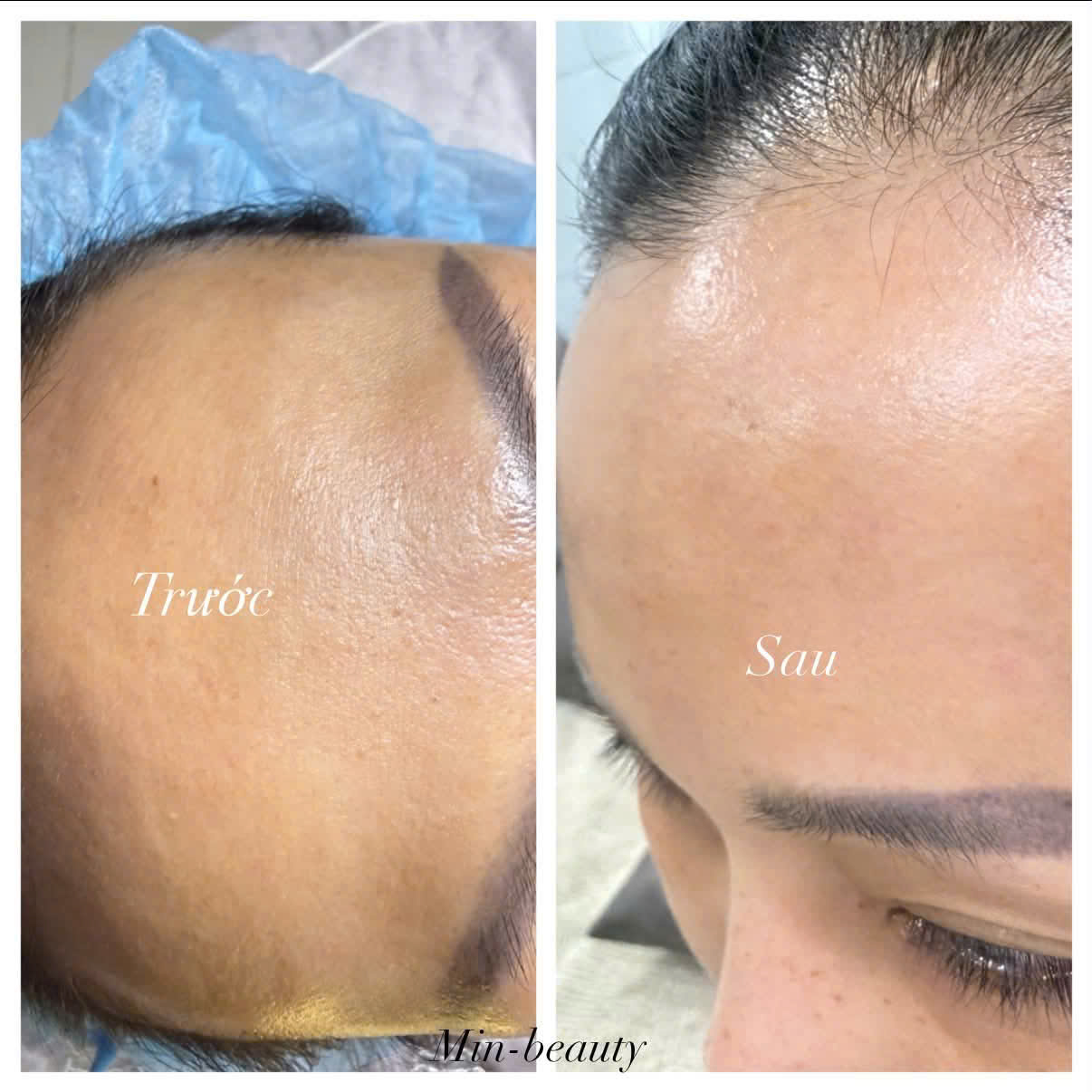Làm đầy trán hóm