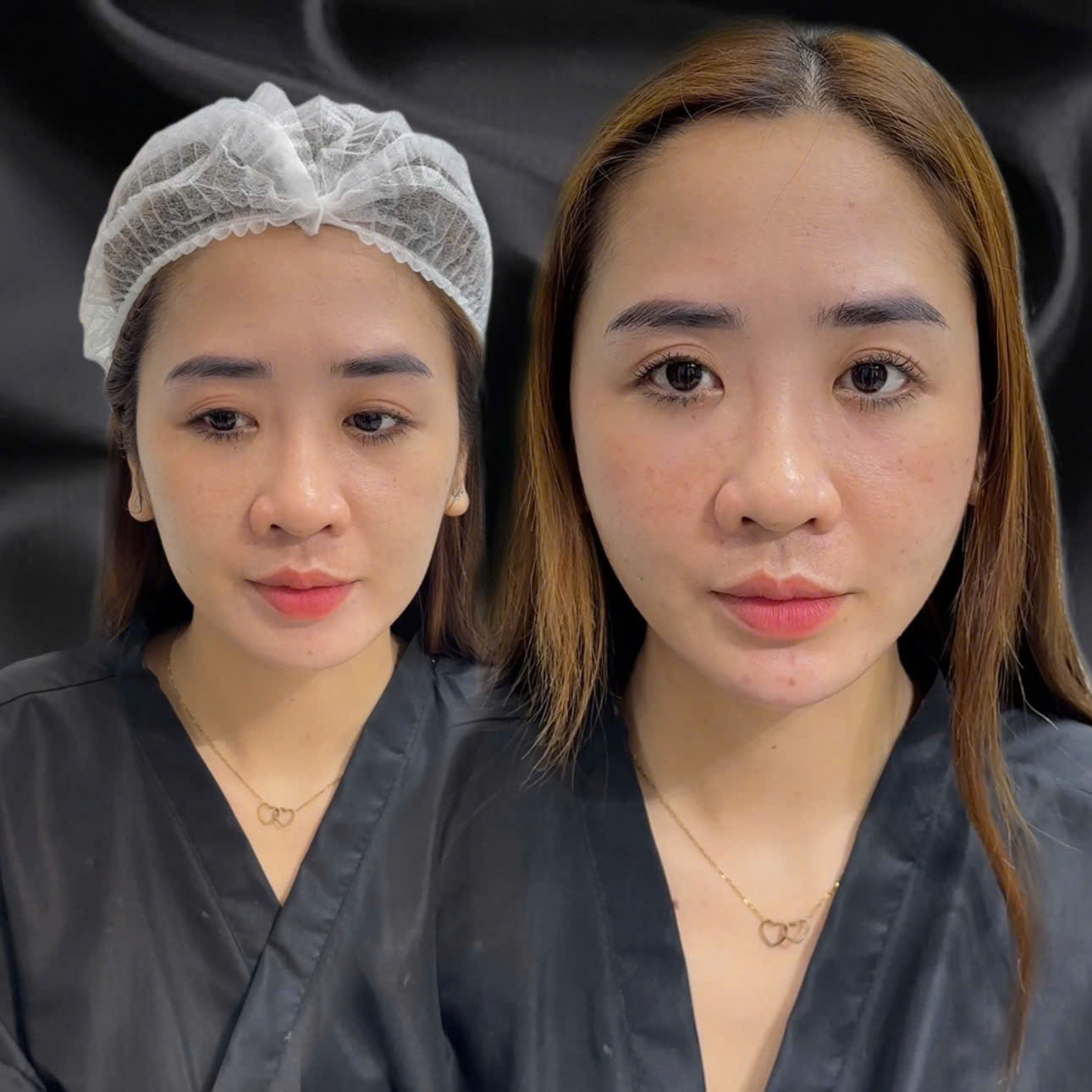 Nâng tầng mặt giữa